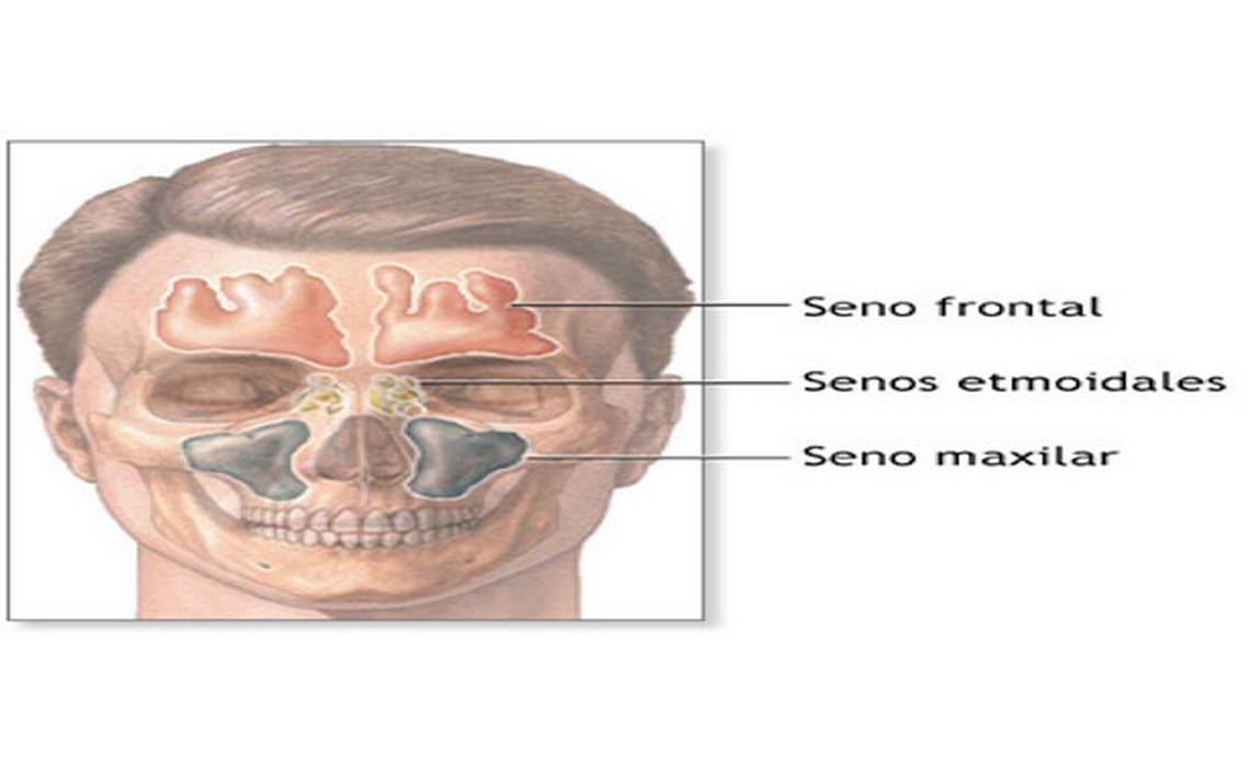 Sinusitis O Rinosinusiti Enfermedad Que Puede Llegar A Causar La